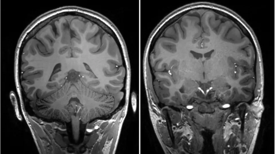 A 7 Tesla MRI of a human brain. Picture. 