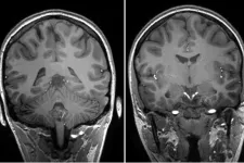 A 7 Tesla MRI of a human brain. Picture. 