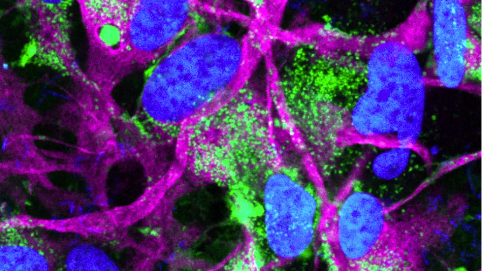 Fotografi på immunohistologisk färgning där alfa-synuklein syns i grönt nära astrocyterna i lila. 