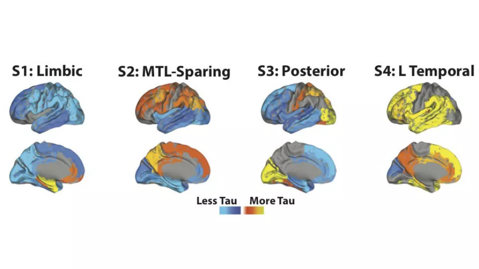 En illustration av sjukdomsspridningen i hjärnan vid fyra olika subtyper av Alzheimers.  Färgkodning visar hur graden av tau-ansamling i olika områden. 