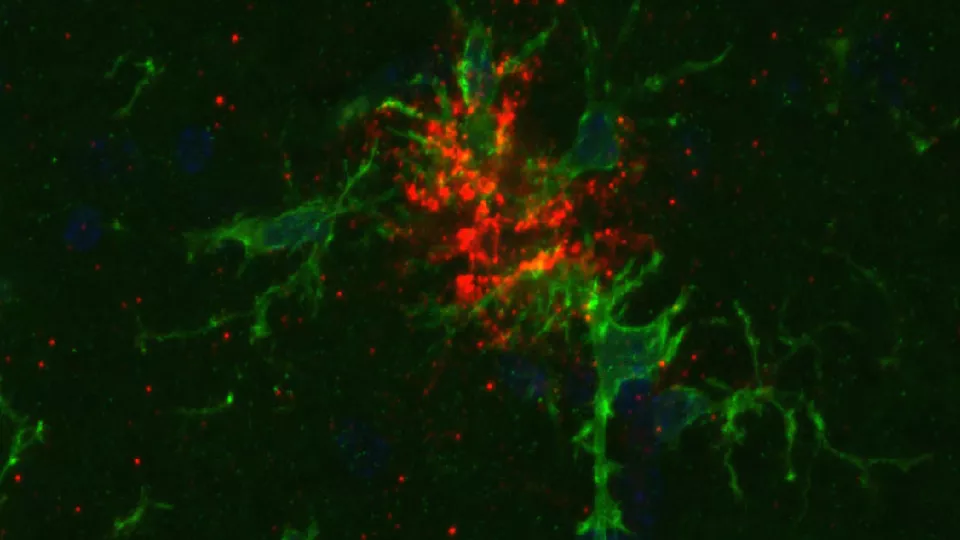En mikroskoperingsbild som visar grönfärgade mikrogilaceller och rödfärgade klumpar av beta-amyloid. 