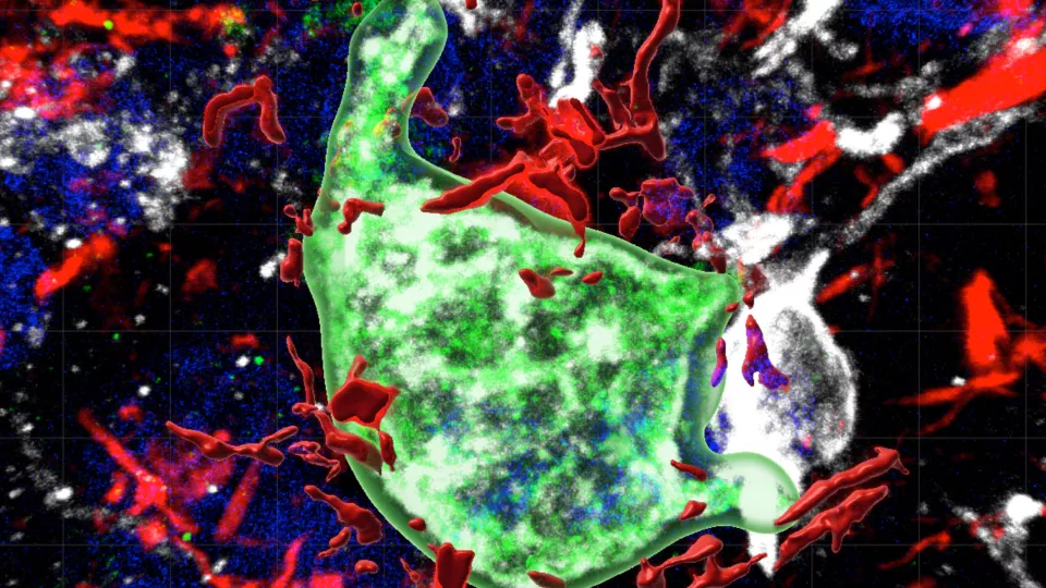 Bild tagen med fluorescensmikroskop där en mikrogliacell som uttrycker Galektin-3 syns i grönt nära tau-proteiner i rött. Bild. 