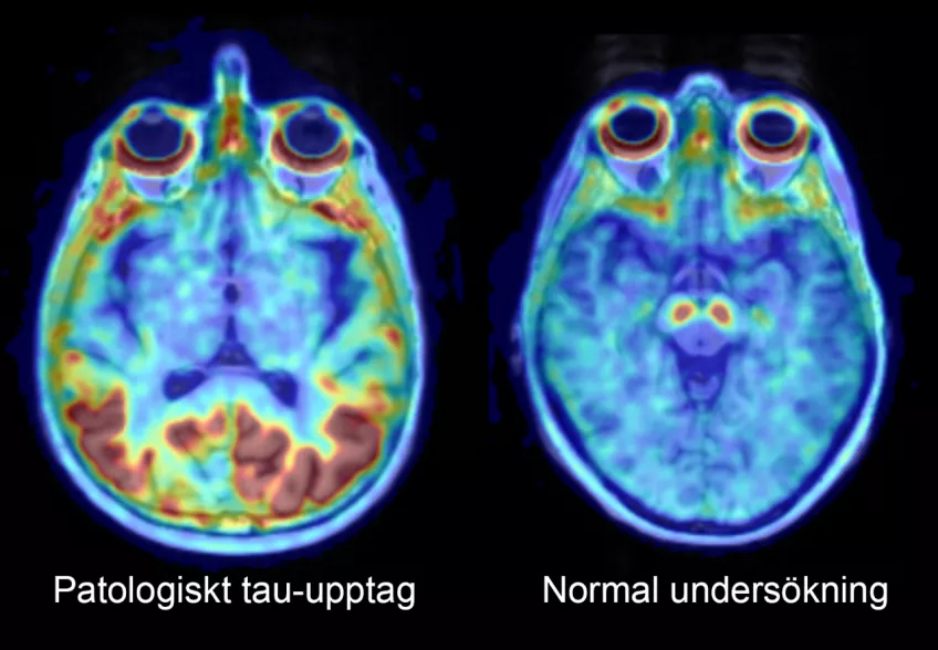 Foto på hjärnavbildning där hjärnan till vänster visar tecken på tau-ansamling, medan den friska hjärnan till höger är normal. 