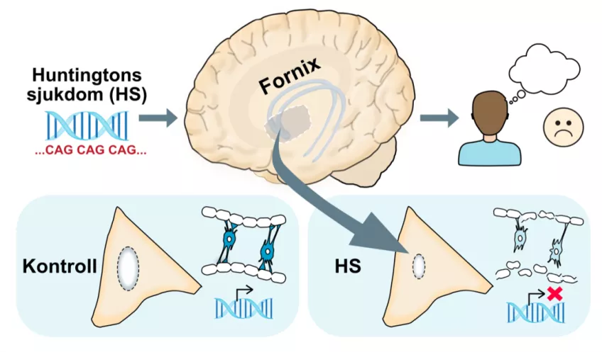 Illustration av hjärnan som visar att cellerna som tillverkar myelin till vitsubstansen i fornix skadas. 